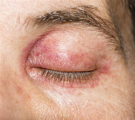 Dandruff flaking can irritate eyelids and cause inflammation. . What causes allergy around eyes